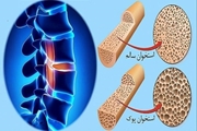 پویش همگانی پوکی استخوان از 28 مهرماه/ پوکی استخوان، یک بیماری خاموش و مزمن است